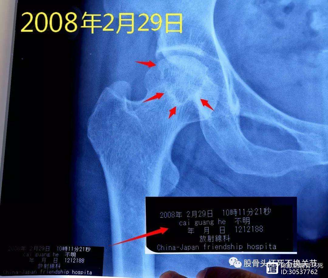 抚顺人工骨头医保报销多少(人工骨头医保报销多少比例)