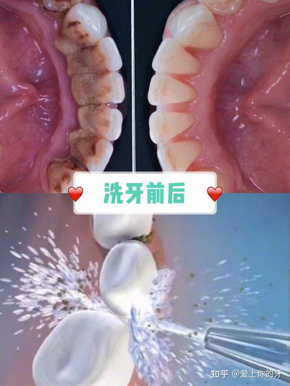 抚顺洗牙可以用医保吗(洗牙可以用医保吗,报销比例多少)